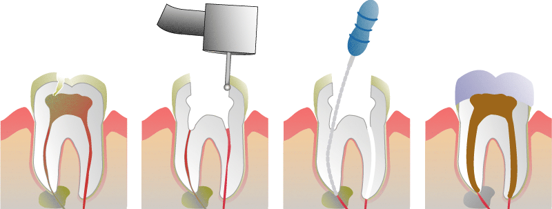 root canal treatment